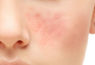treating acne - Accutane BE