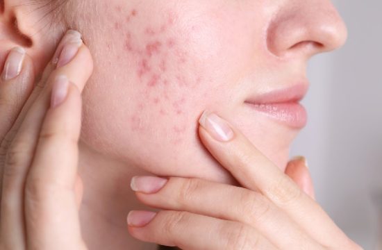 Buy Ultima-Accutane Online